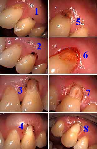cervical gum line dental bonding, class 5, toothbrush erosion tooth abrasion composite resins teeth