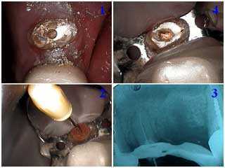 Obturation in endodontics, root canal therapy, seal apical third, measurement, isolation