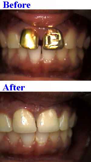 close teeth gap tooth space spacing gaps spaces remove gold dental porcelain crowns caps