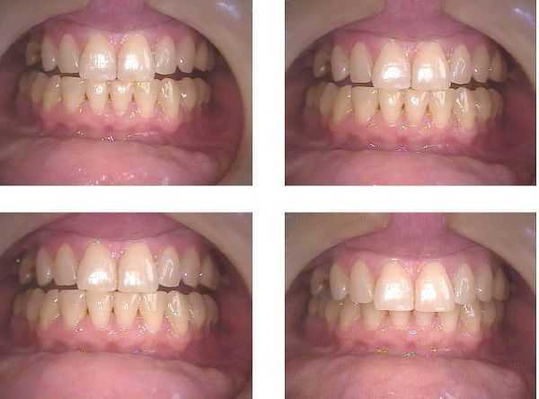 A collapsed bite or closed bite may cause malocclusion