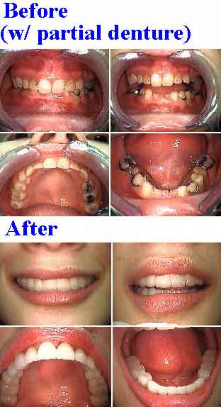Full mouth reconstruction partial anodontia, retained baby teeth
