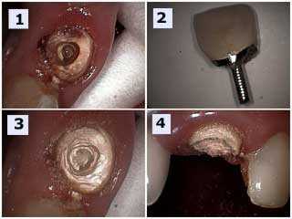 Post and Cores, cast gold, prefabricated cavity tooth dental caries preparation technique crown