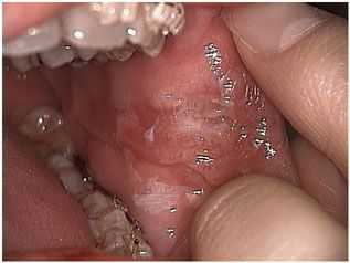 Cheek Biting, curve of Spee, teeth Bite, dental occlusion, position, habits, orthodontic brackets