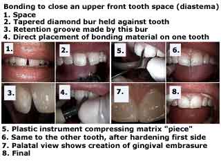Composite Resin Bonding technique procedure how to close a diastema front tooth space, composite