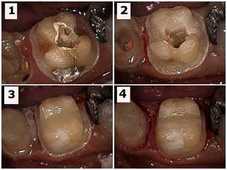 composite resin dental bonding build-up core buildup drilling into root canal orifices teeth tooth