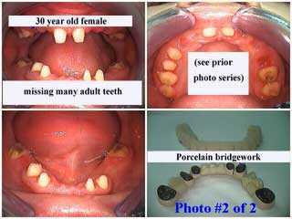 Full mouth reconstruction for partial anodontia, Bridges, fixed caps, dental crowns, porcelain metal tooth teeth ceramic, pfm
