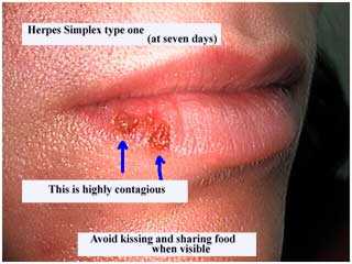mouth herpes type 1 I one labialis lip, cold sores, fever blister, sun blister, contagious oral sex 