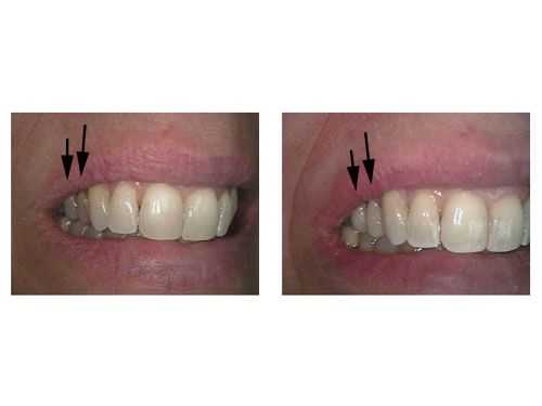 Crooked tooth, Rotated Premolar Tooth, crooked teeth Rotation, Composite resin dental bonding crowded