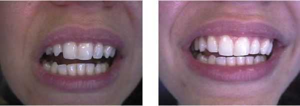 Bonding gaps between teeth with high end composite resins.