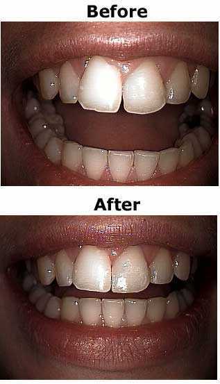 Cosmetic Dentistry, Sculpting, Shaping, Bonding gaps, Reshaping, white dental filling fillings