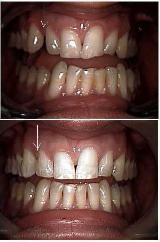 aesthetic dentistry Cosmetic Dentistry, Sculpting, Shaping, Bonding, Filling Spaces, Reshaping, incisal occlusal adjust