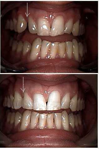 Bonding gaps, White Fillings, fillins, Sculpting, Shaping, Filling in Spaces, Reshaping