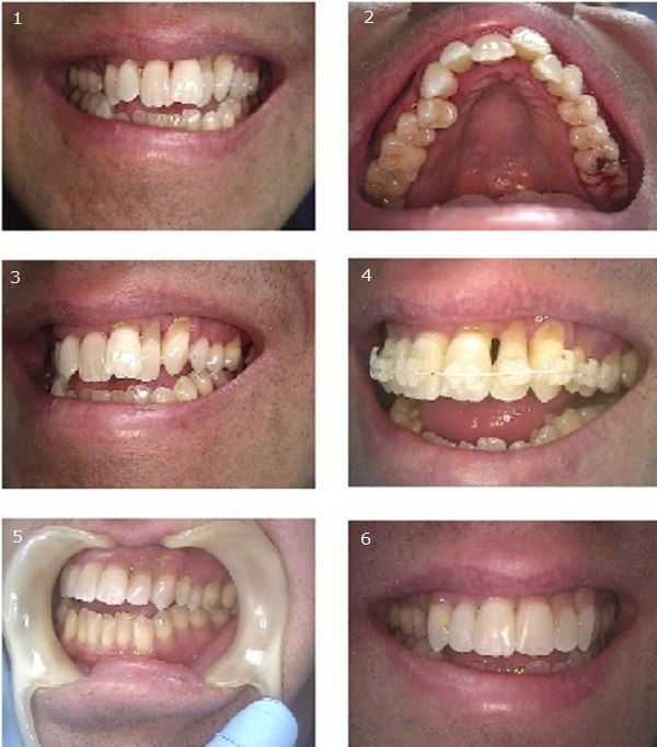 Tooth erosion or abrasion from toothbrushing at gums