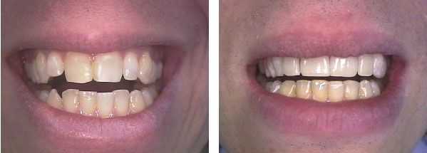 NY porcelain veneers, cosmetic dentistry with four upper front porcelain veneers and dental bonding on a lower right canine