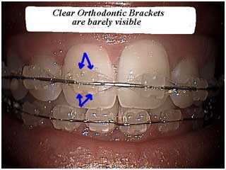 Cosmetic esthetic fixed faster braces that have clear brackets and invisible accelerated orthodontics.