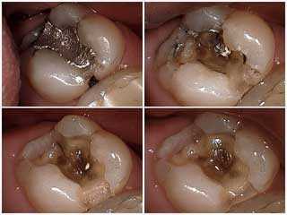 cracks tooth fracture decay teeth craze lines deep silver fillings tooth amalgam chipped teeth
