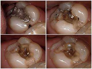 Maxillary lateral incisor with cracks (labial view). (a) Craze lines on