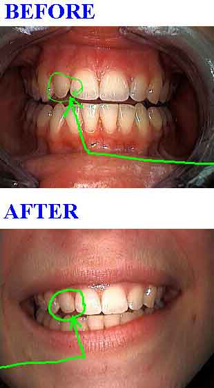 Bonding gaps between teeth with high end composite resins.