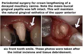 Periodontal gum surgery gingival teeth crown lengthening decay maxillary canine crowns caps