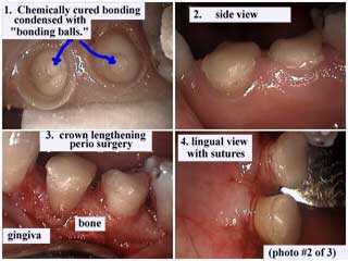 dental crown buildup tooth bonding composite condensation condenser bonding ball, restoration