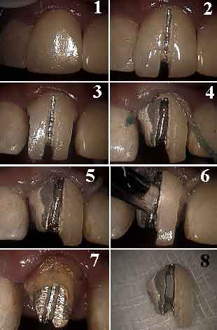 gentle removal cutting drilling sectioning of a porcelain metal crown cap bridge, oral, mouth how to