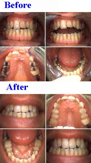 Office bleaching and professional teeth whitening before and after photos for yellow color coffee stains.