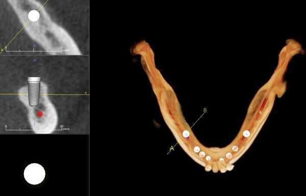 CT scan, CAT scan, lower jaw, mandible, dental implants, implant dentistry, occlusal view, top