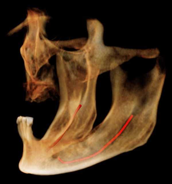 CT scan, CAT scan, upper and lower jaw, maxilla, mandible, dental implants, side view, lateral