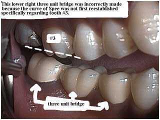 curve of spee, occlusion, bite, dental articulator, bite adjustment, occlusal analysis, facebow