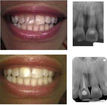 Discolored Stained Dark or Black Teeth Whitening after Root Canal.