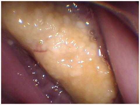 Dead Jaw Syndrome, Fosamax, Aredia, Bisphosphonates, Avascular Aseptic Necrosis, ONJ, BRONJ