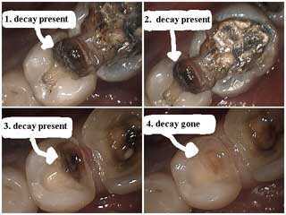 decay, cavity, caries, diagnosis, clinical oral examination, intraoral exam teeth tooth smile