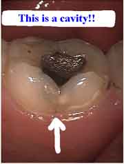 decay, cavity, caries, fracture crack craze lines, diagnosis, clinical examination oral mouth pain