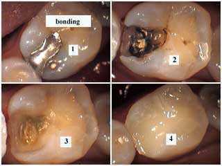 white tooth fillings, white composite resins, decay cavity caries dental bonding bonded