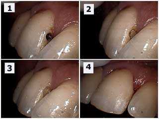 The cavity of the tooth #16 after the removal of the temporary and