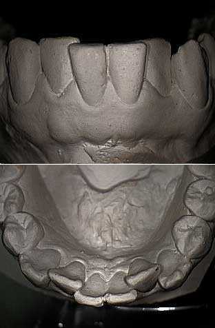 dental arch plaster study models, orthodontics, braces, relapse, teeth crowding