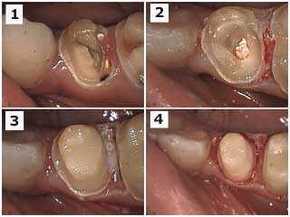 dental bonding build-up, composite core buildup herculite xrv, drill tooth preparation drilling