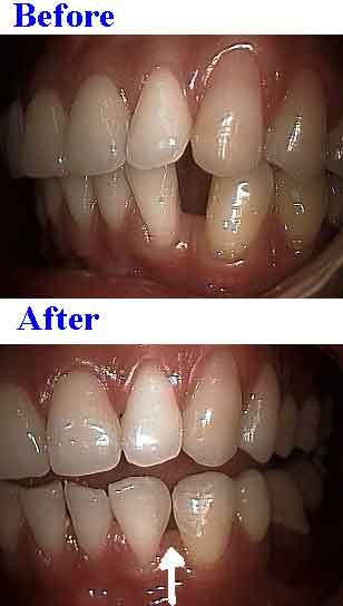 dental bonding gaps for lower front tooth filling spaces, teeth gap space