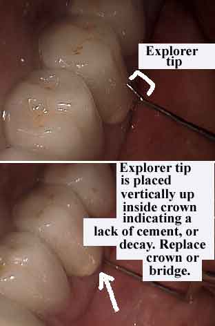 dental cement wash out leakage, teeth bridge, caps, dentist crowns leak tooth, glue