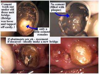 dental cement wash out of glass ionomer zinc phosphate, ZnPO4, bridge repair, complications, caps