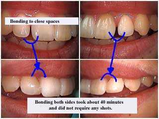 Dental Composite Resin Bonding Gap 1169 