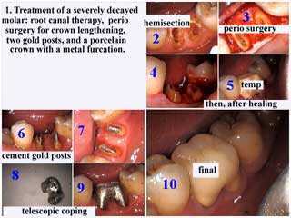 how to crown caps technique method molar tooth decay cavity, metal furcation, gold posts cut gum