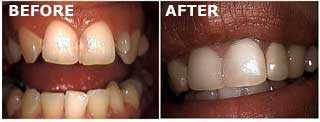 New York Smile Makeover of a peg lateral tooth with a porcelain crown or dental cap, peg-shaped