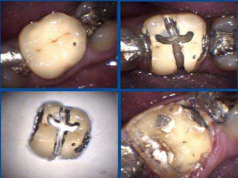 dental crown removal cap remove take off sectioning cutting caps how to drill drilling technique