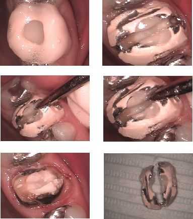 dental crown removal, how to remove a tooth cap, Black Swan,