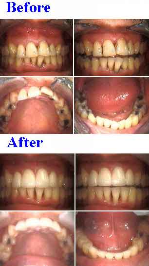 dental bonding composite tooth restorations, white teeth fillings, operative dentistty
