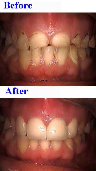 porcelain crowns, short teeth, esthetic composite resin bonded teeth filling gumline