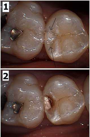 Tooth Decay Cavity dental Diagnosis Teeth Color shade pictures