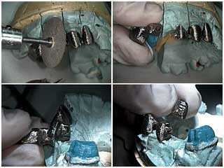 burs, dental drill drilling sectioning metal  framework, porcelain-metal bridge,  solder transfer