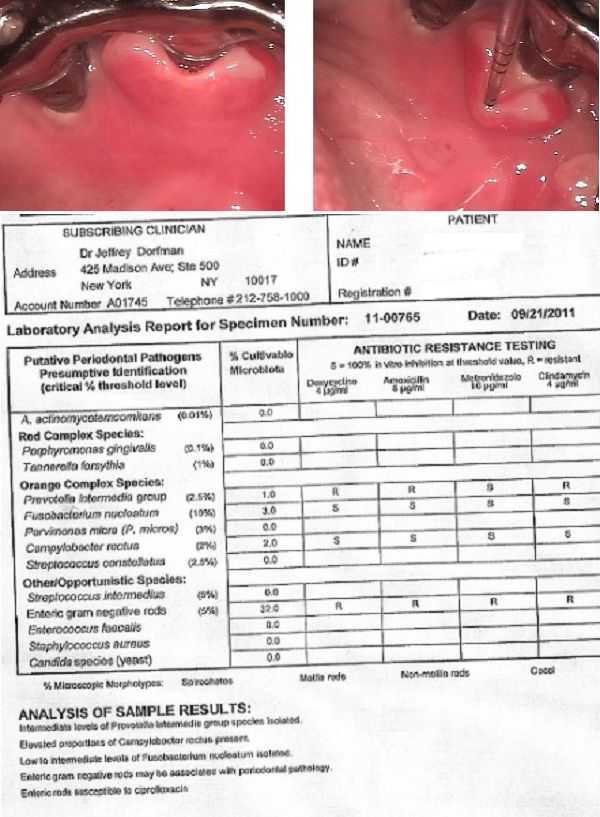 Dental implant complication problems, gum infection, culture, bacteria, pain